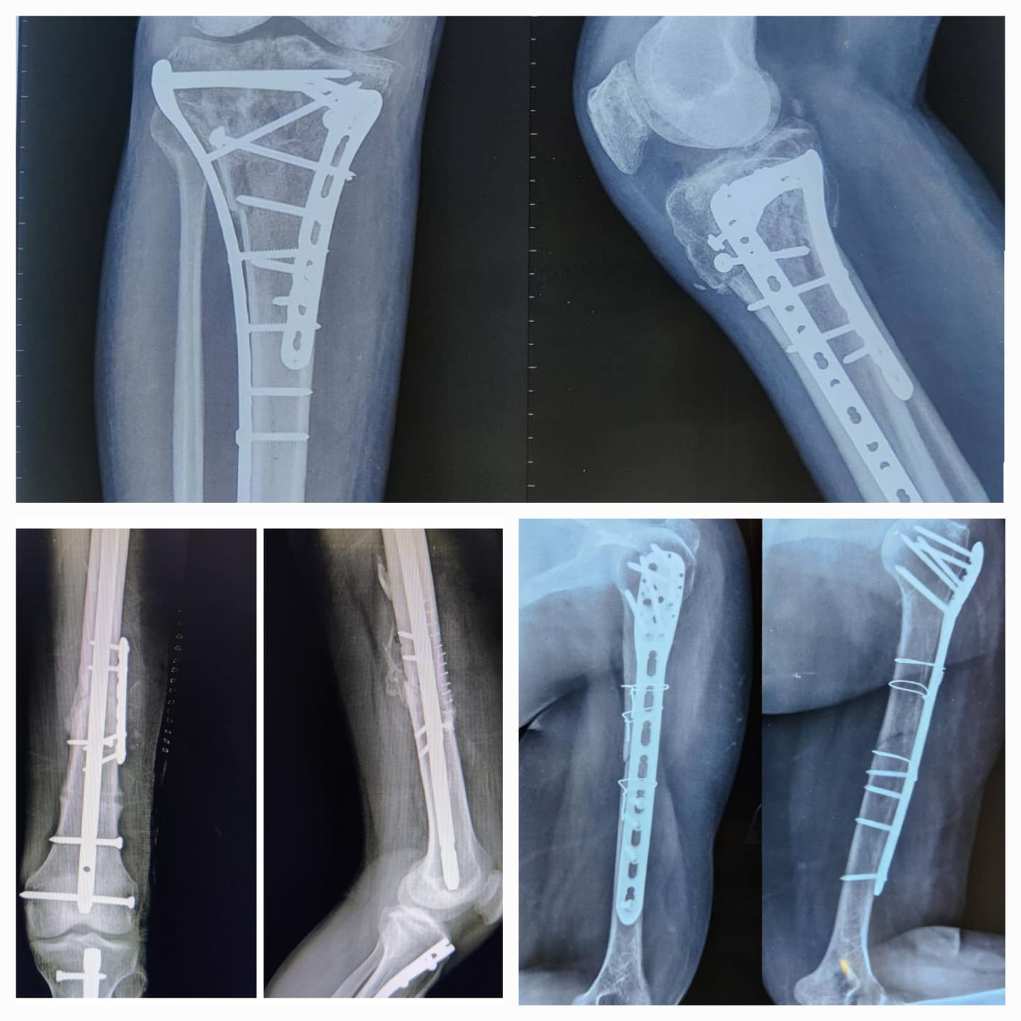 COMPLEX TRAUMA CASES
